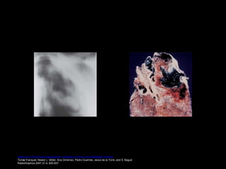 Spectrum of Pulmonary Aspergillosis: Histologic, Clinical, and Radiologic Findings
Tomás Franquet, Nestor L. Müller, Ana Giménez, Pedro Guembe, Jesus de la Torre, and S. Bagué
RadioGraphics 2001 21:4, 825-837
 