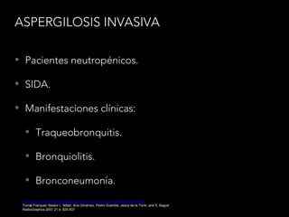 ASPERGILOSIS INVASIVA
• Pacientes neutropénicos.
• SIDA.
• Manifestaciones clínicas:
• Traqueobronquitis.
• Bronquiolitis.
• Bronconeumonía.
Spectrum of Pulmonary Aspergillosis: Histologic, Clinical, and Radiologic Findings
Tomás Franquet, Nestor L. Müller, Ana Giménez, Pedro Guembe, Jesus de la Torre, and S. Bagué
RadioGraphics 2001 21:4, 825-837
 