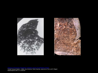 Spectrum of Pulmonary Aspergillosis: Histologic, Clinical, and Radiologic Findings
Tomás Franquet, Nestor L. Müller, Ana Giménez, Pedro Guembe, Jesus de la Torre, and S. Bagué
RadioGraphics 2001 21:4, 825-837
 