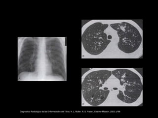 Diagnostico Radiológico de las Enfermedades del Tórax. N. L. Muller, R. S. Fraser,. Elsevier-Masson, 2003. p186
 
