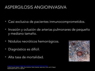 ASPERGILOSIS ANGIOINVASIVA
• Casi exclusiva de pacientes inmunocomprometidos.
• Invasión y oclusión de arterias pulmonares de pequeño
y mediano tamaño.
• Nódulos necróticos hemorrágicos.
• Diagnóstico es difícil.
• Alta tasa de mortalidad.
Spectrum of Pulmonary Aspergillosis: Histologic, Clinical, and Radiologic Findings
Tomás Franquet, Nestor L. Müller, Ana Giménez, Pedro Guembe, Jesus de la Torre, and S. Bagué
RadioGraphics 2001 21:4, 825-837
 