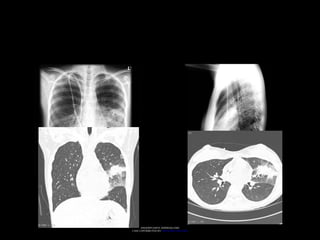 ANGIOINVASIVE ASPERGILLOSIS
CASE CONTRIBUTED BY: DR FRANK GAILLARD
 