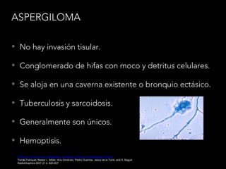 ASPERGILOMA
• No hay invasión tisular.
• Conglomerado de hifas con moco y detritus celulares.
• Se aloja en una caverna existente o bronquio ectásico.
• Tuberculosis y sarcoidosis.
• Generalmente son únicos.
• Hemoptisis.
Spectrum of Pulmonary Aspergillosis: Histologic, Clinical, and Radiologic Findings
Tomás Franquet, Nestor L. Müller, Ana Giménez, Pedro Guembe, Jesus de la Torre, and S. Bagué
RadioGraphics 2001 21:4, 825-837
 