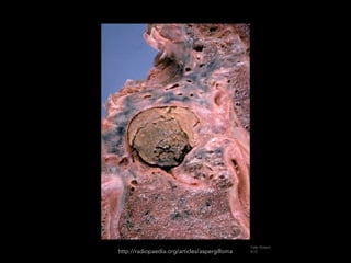 Yale Rosen,
M.D.http://radiopaedia.org/articles/aspergilloma
 