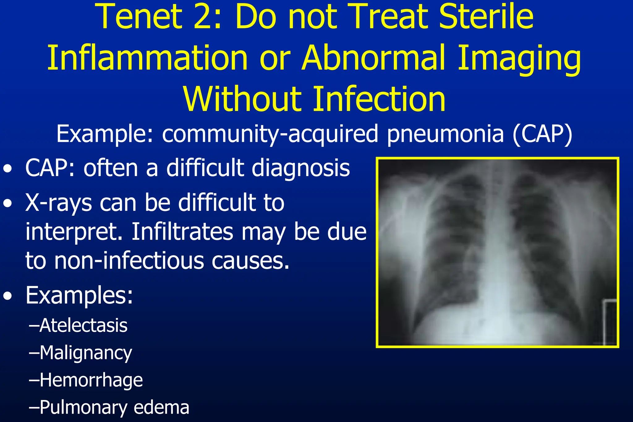• CAP: often a difficult diagnosis
• X-rays can be difficult to
interpret. Infiltrates may be due
to non-infectious causes.
• Examples:
–Atelectasis
–Malignancy
–Hemorrhage
–Pulmonary edema
Tenet 2: Do not Treat Sterile
Inflammation or Abnormal Imaging
Without Infection
Example: community-acquired pneumonia (CAP)
 