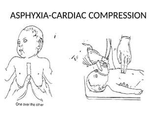 Comprehensive Overview of Birth Asphyxia: Causes, Diagnosis, and ...