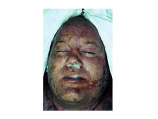 Asphyxia presentation