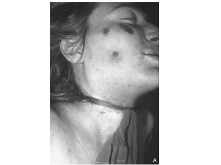 Asphyxia presentation