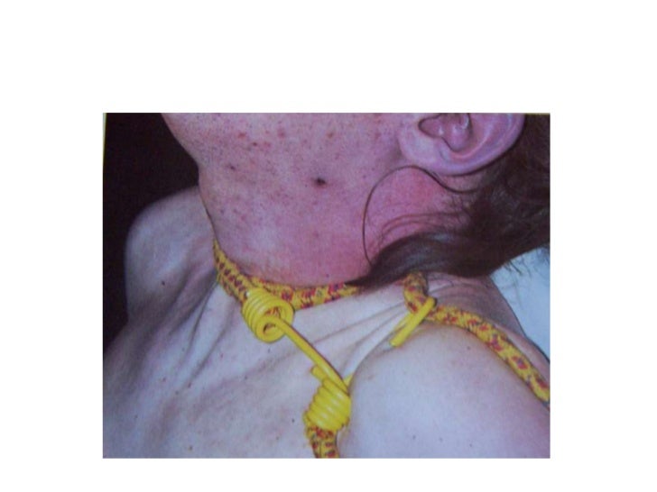 Manual Strangulation Throttling