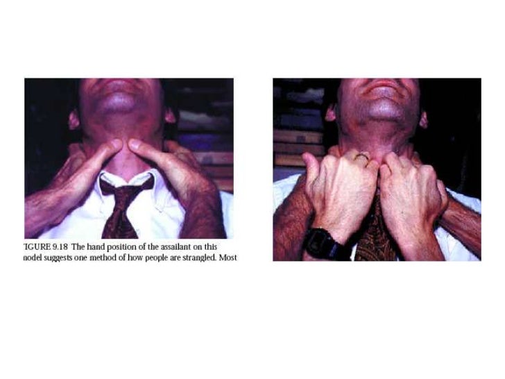 Asphyxia presentation