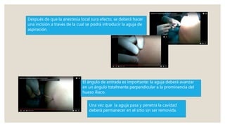 Después de que la anestesia local sura efecto, se deberá hacer
una incisión a través de la cual se podrá introducir la aguja de
aspiración.
El ángulo de entrada es importante: la aguja deberá avanzar
en un ángulo totalmente perpendicular a la prominencia del
hueso iliaco.
Una vez que la aguja pasa y penetra la cavidad
deberá permanecer en el sitio sin ser removida.
 