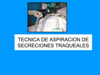TECNICA DE ASPIRACION DE
SECRECIONES TRAQUEALES

 