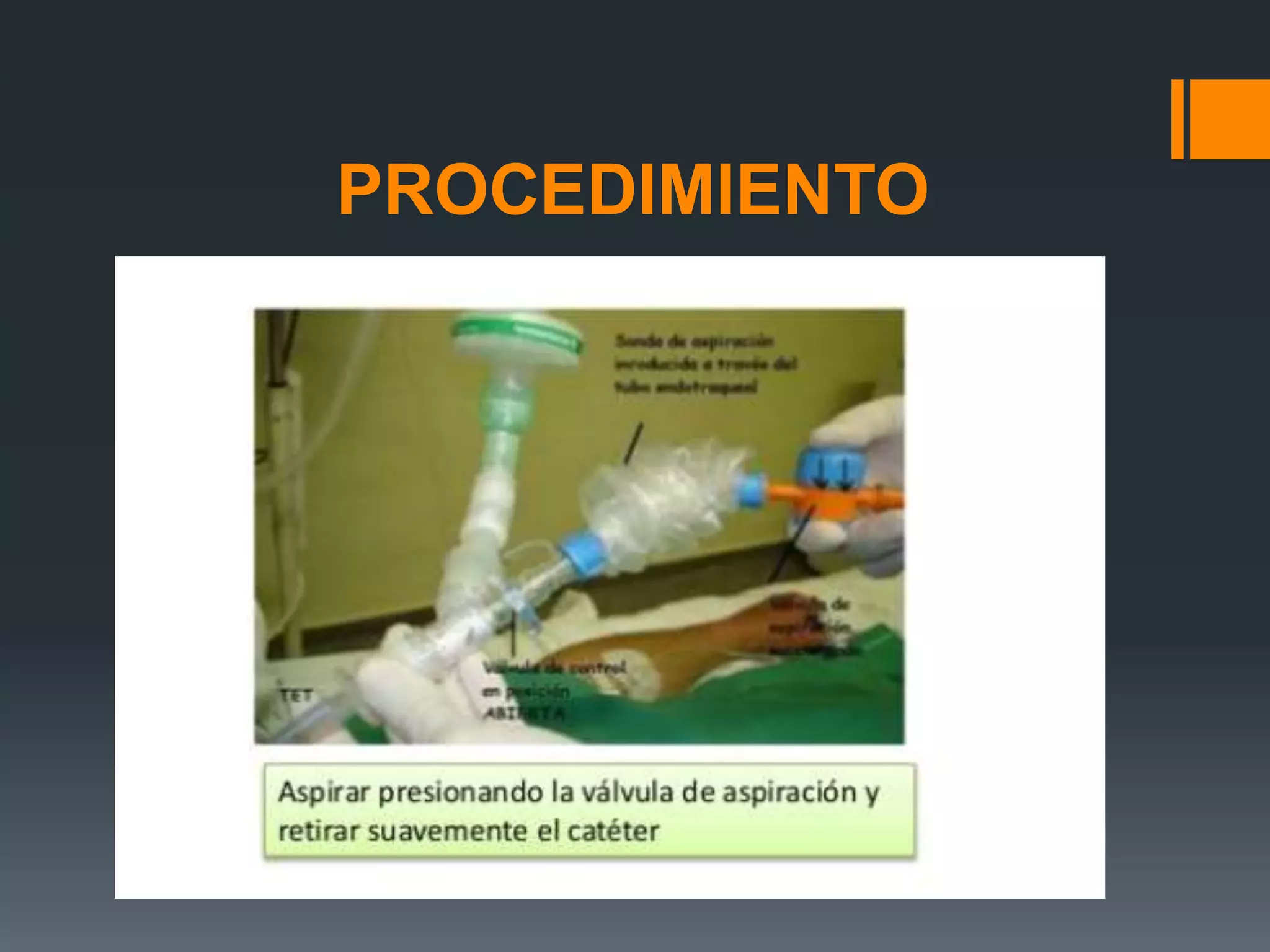 Aspiracion de secreciones sistema abierto y cerrado | PPTX