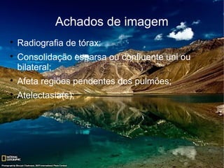 Achados de imagem

    Radiografia de tórax:

    Consolidação esparsa ou confluente uni ou
    bilateral;

    Afeta regiões pendentes dos pulmões;

    Atelectasia(s);
 