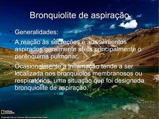 Bronquiolite de aspiração

    Generalidades:

    A reação às secreções e aos alimentos
    aspirados geralmente afeta principalmente o
    parênquima pulmonar.

    Ocasionalmente a inflamação tende a ser
    localizada nos bronquíolos membranosos ou
    respiratórios, uma situação que foi designada
    bronquiolite de aspiração.
 