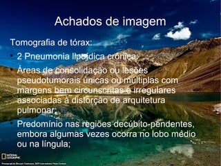 Achados de imagem
Tomografia de tórax:

    2 Pneumonia lipoídica crônica:

    Áreas de consolidação ou lesões
    pseudotumorais únicas ou múltiplas com
    margens bem circunscritas e irregulares
    associadas à distorção de arquitetura
    pulmonar;

    Predomínio nas regiões decúbito-pendentes,
    embora algumas vezes ocorra no lobo médio
    ou na língula;
 