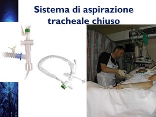 Sistema di aspirazione
tracheale chiuso
 