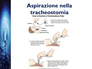 Aspirazione nella
tracheostomia
 