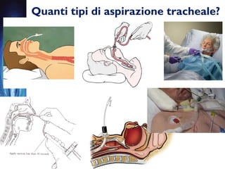 Quanti tipi di aspirazione tracheale?
 