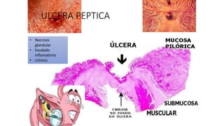 ULCERA PEPTICA
• Necrosis
glandular
• Exudado
inflamatorio
• crónico
 