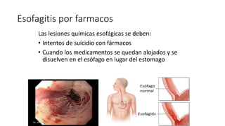 Esofagitis por farmacos
Las lesiones químicas esofágicas se deben:
• Intentos de suicidio con fármacos
• Cuando los medicamentos se quedan alojados y se
disuelven en el esófago en lugar del estomago
 