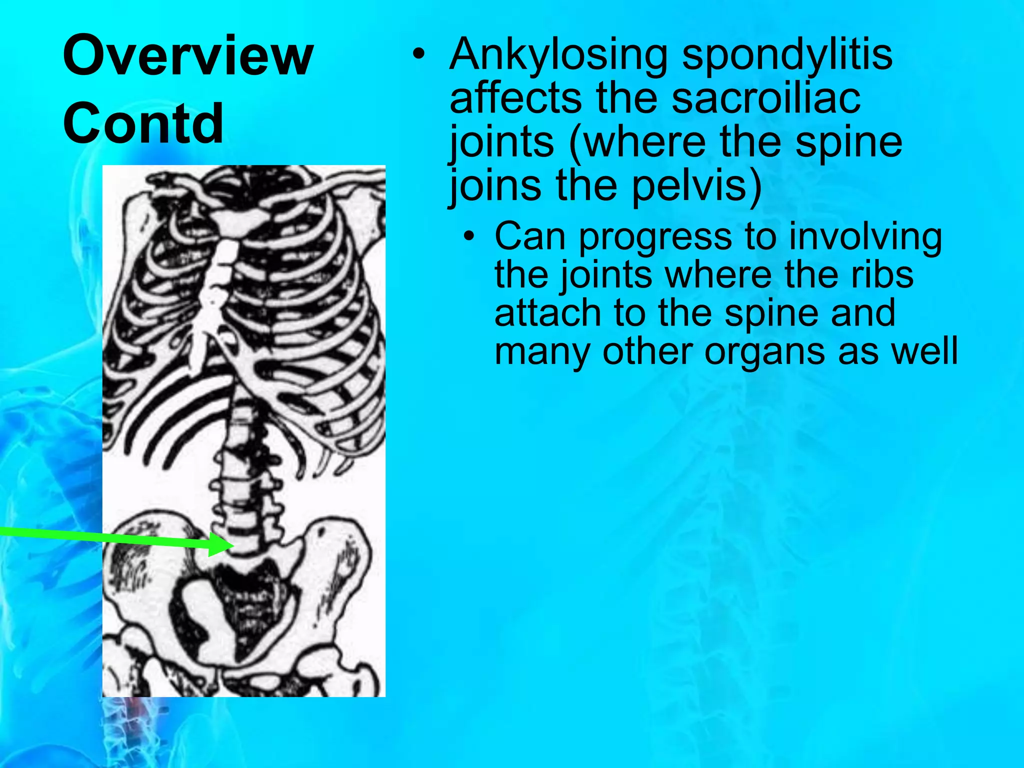 Spondylitis Ribs Ankylosing Spondylitis | PPTX