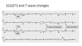 S1Q3T3 and T wave changes
 