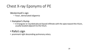 Chest X-ray Eponyms of PE
29
Westermark's sign
• Focal , demarcated oligaemia
• Hampton’s Hump
• A triangular or rounded pleural-based infiltrate with the apex toward the hilum,
usually located adjacent to the hilum.
• Palla’s sign
• prominent right descending pulmonary artery
 