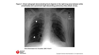 Figure 1. Chest radiograph demonstrating focal oligemia in the right lung (area between white
arrowheads) and a prominent right descending pulmonary artery (black arrow).
Shiva Sreenivasan et al. Circulation. 2007;115:e211
Copyright © American Heart Association, Inc. All rights reserved.
 