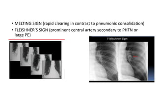• MELTING SIGN (rapid clearing in contrast to pneumonic consolidation)
• FLEISHNER’S SIGN (prominent central artery secondary to PHTN or
large PE)
 