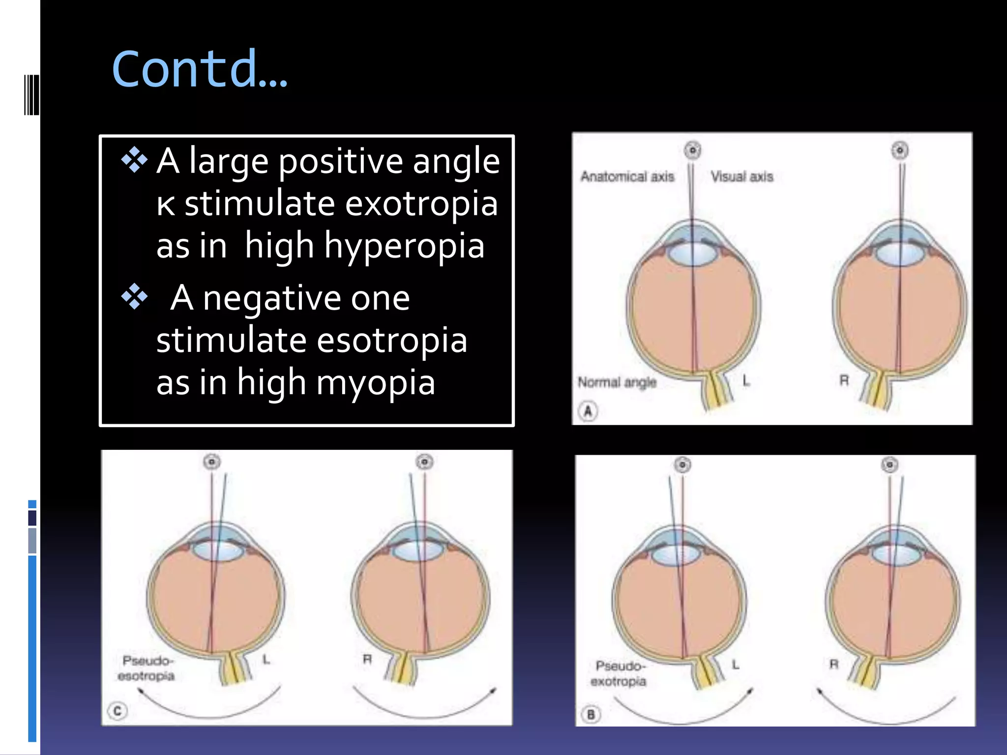 Contd…
A large positive angle
κ stimulate exotropia
as in high hyperopia
 A negative one
stimulate esotropia
as in high myopia
 
