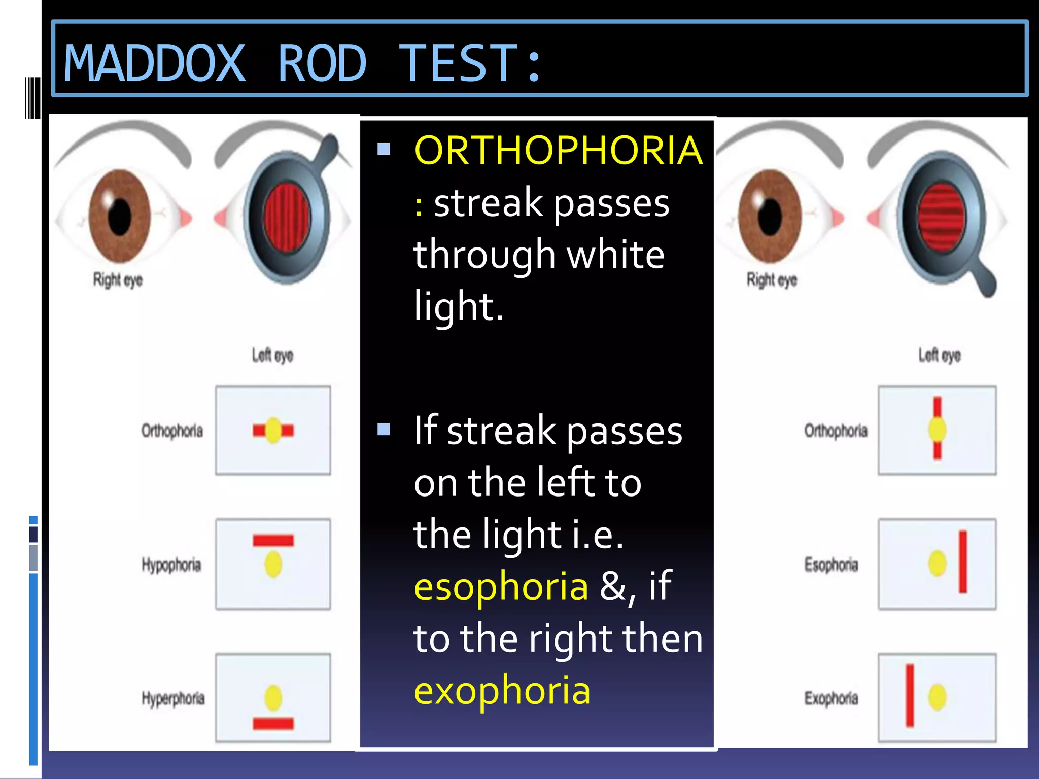 MADDOX ROD TEST:
 ORTHOPHORIA
: streak passes
through white
light.
 If streak passes
on the left to
the light i.e.
esophoria &, if
to the right then
exophoria
 