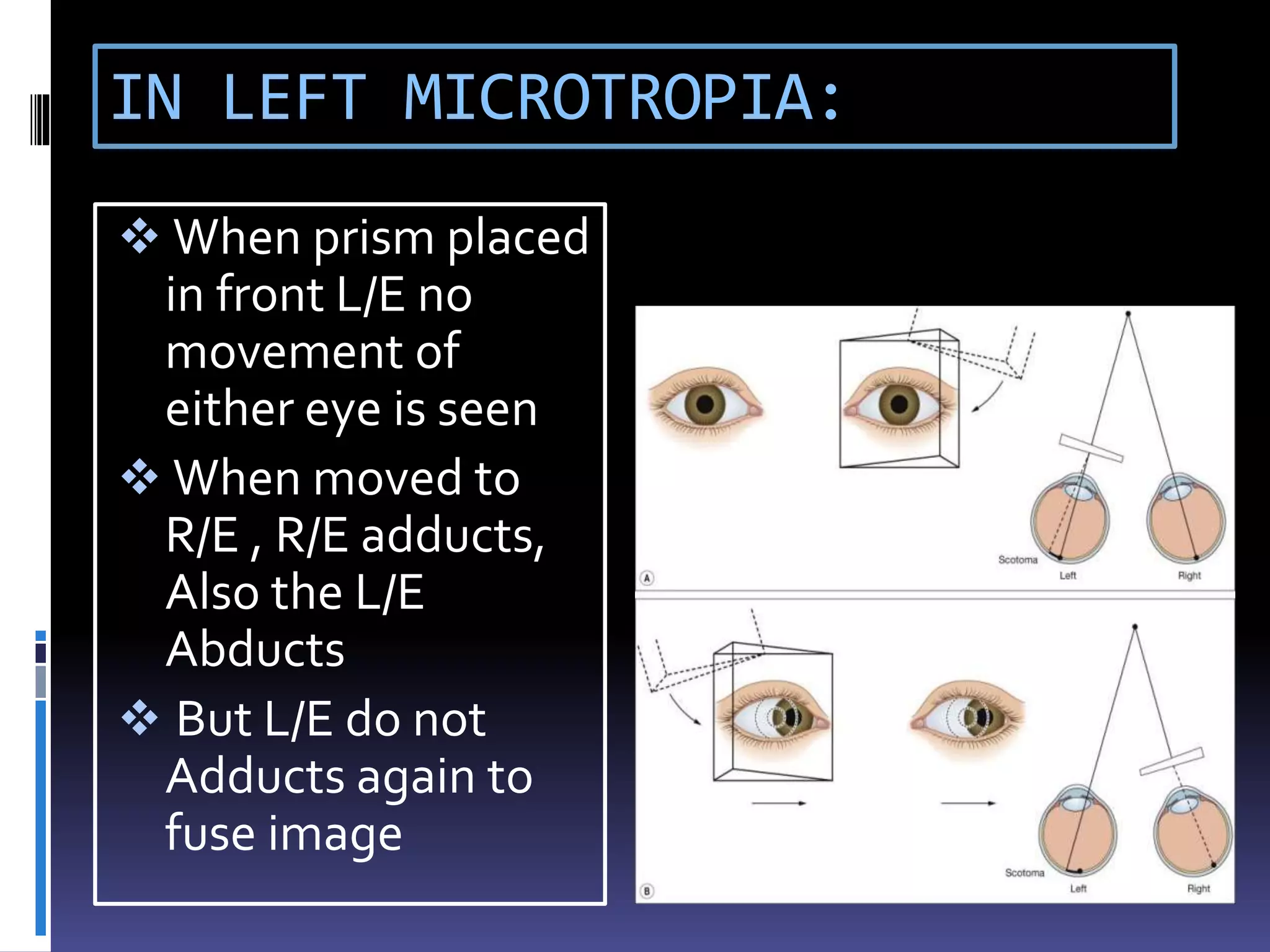 IN LEFT MICROTROPIA:
 When prism placed
in front L/E no
movement of
either eye is seen
 When moved to
R/E , R/E adducts,
Also the L/E
Abducts
 But L/E do not
Adducts again to
fuse image
 