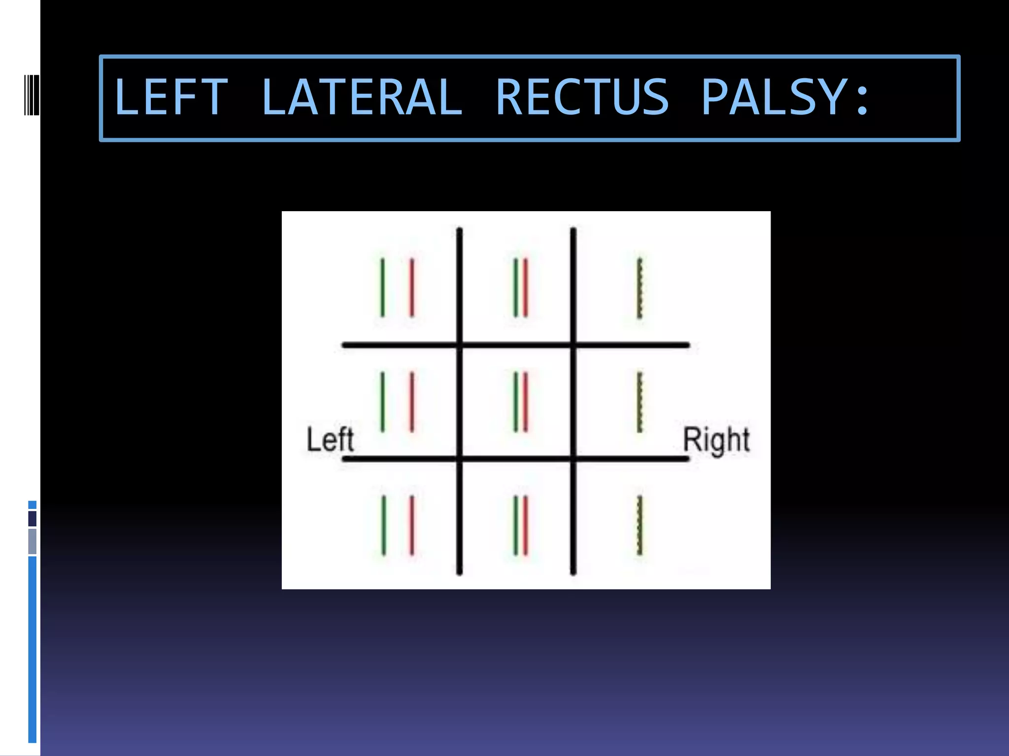 LEFT LATERAL RECTUS PALSY:
 