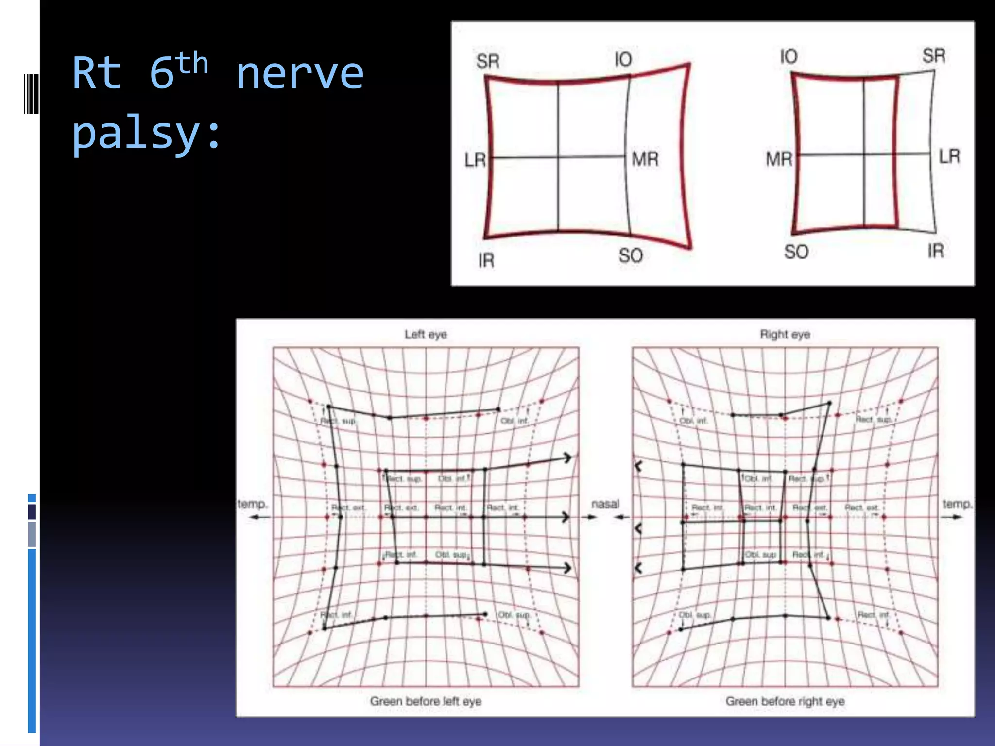 Rt 6th nerve
palsy:
 