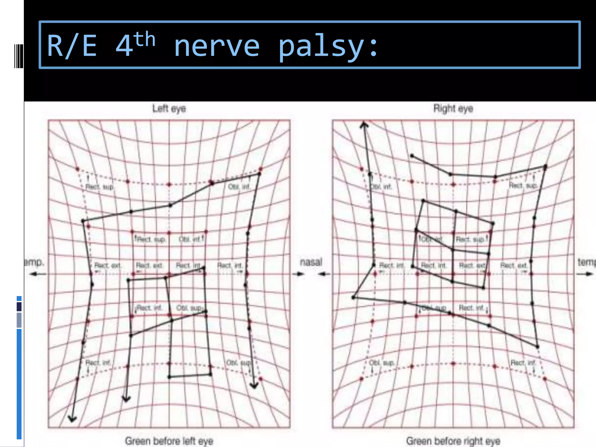 R/E 4th nerve palsy:
 