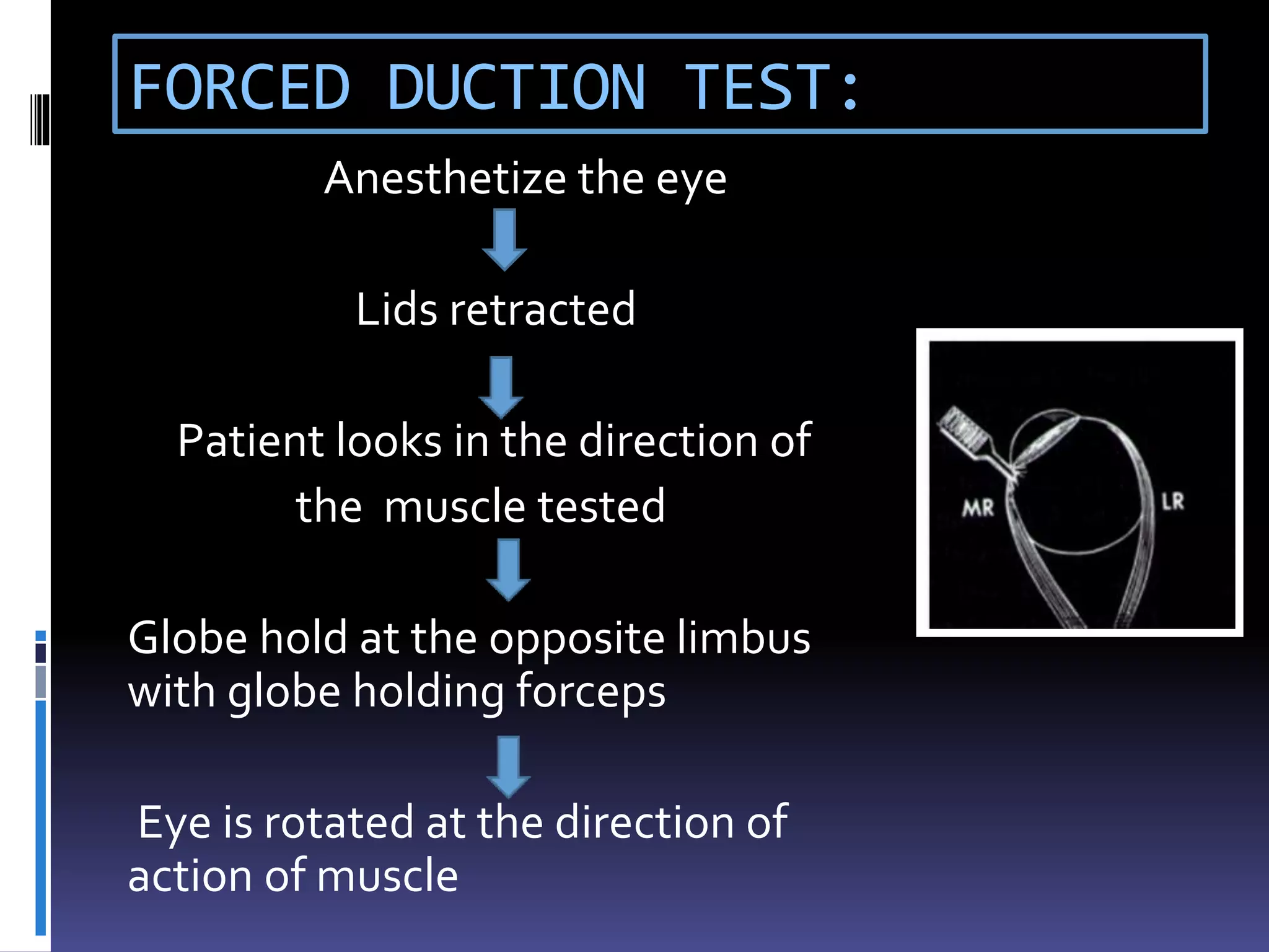 FORCED DUCTION TEST:
Anesthetize the eye
Lids retracted
Patient looks in the direction of
the muscle tested
Globe hold at the opposite limbus
with globe holding forceps
Eye is rotated at the direction of
action of muscle
 
