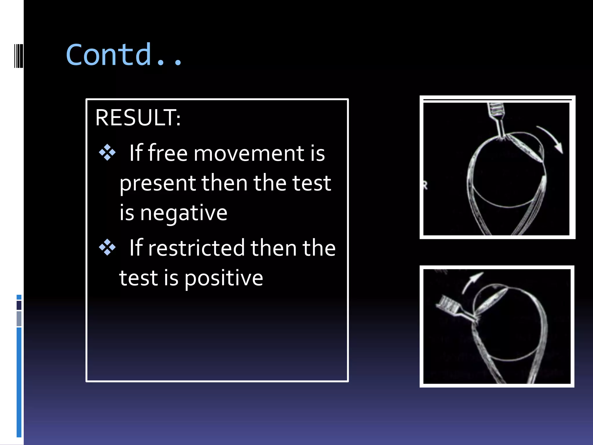 Contd..
RESULT:
 If free movement is
present then the test
is negative
 If restricted then the
test is positive
 