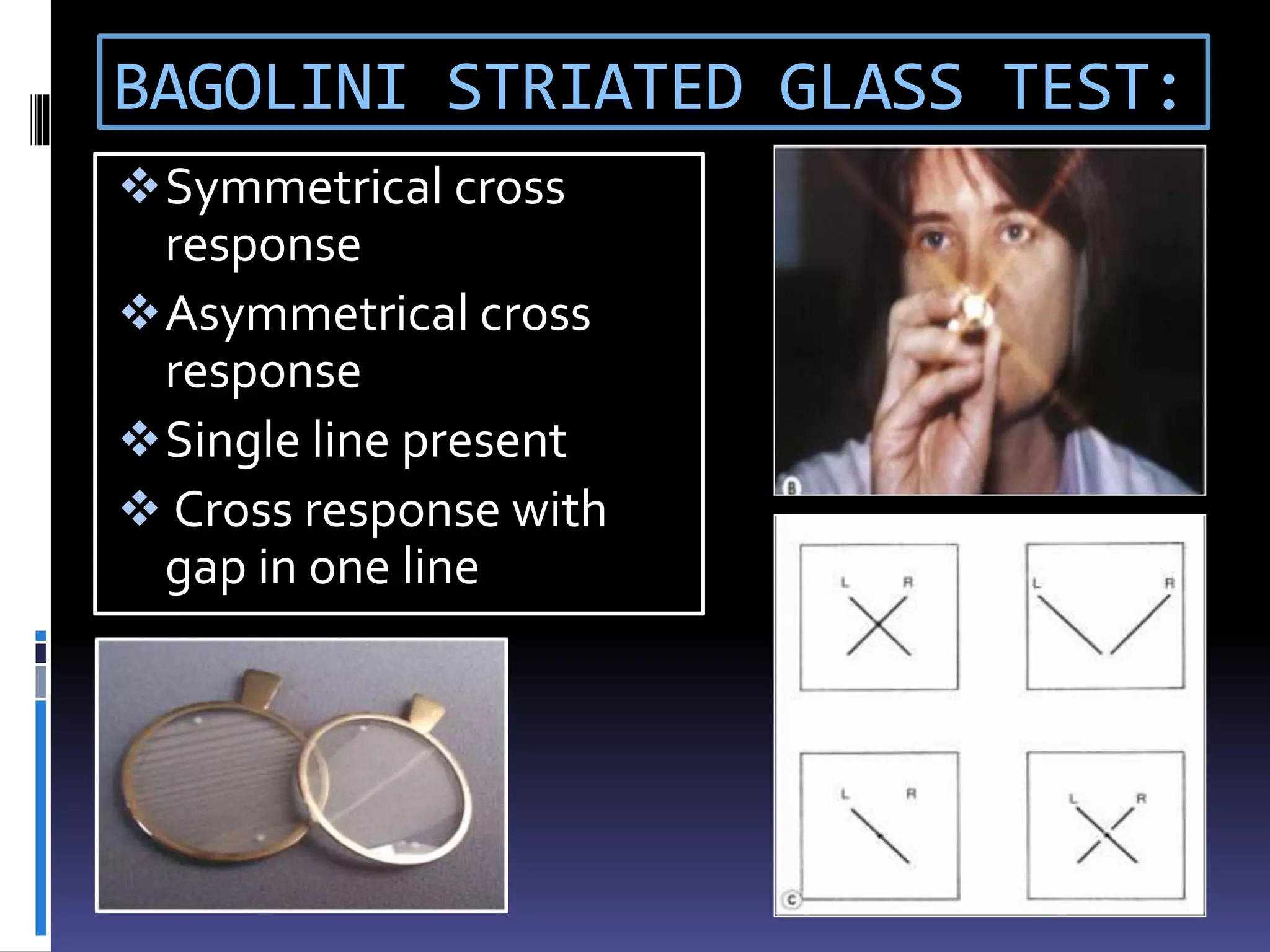 BAGOLINI STRIATED GLASS TEST:
Symmetrical cross
response
Asymmetrical cross
response
Single line present
 Cross response with
gap in one line
 