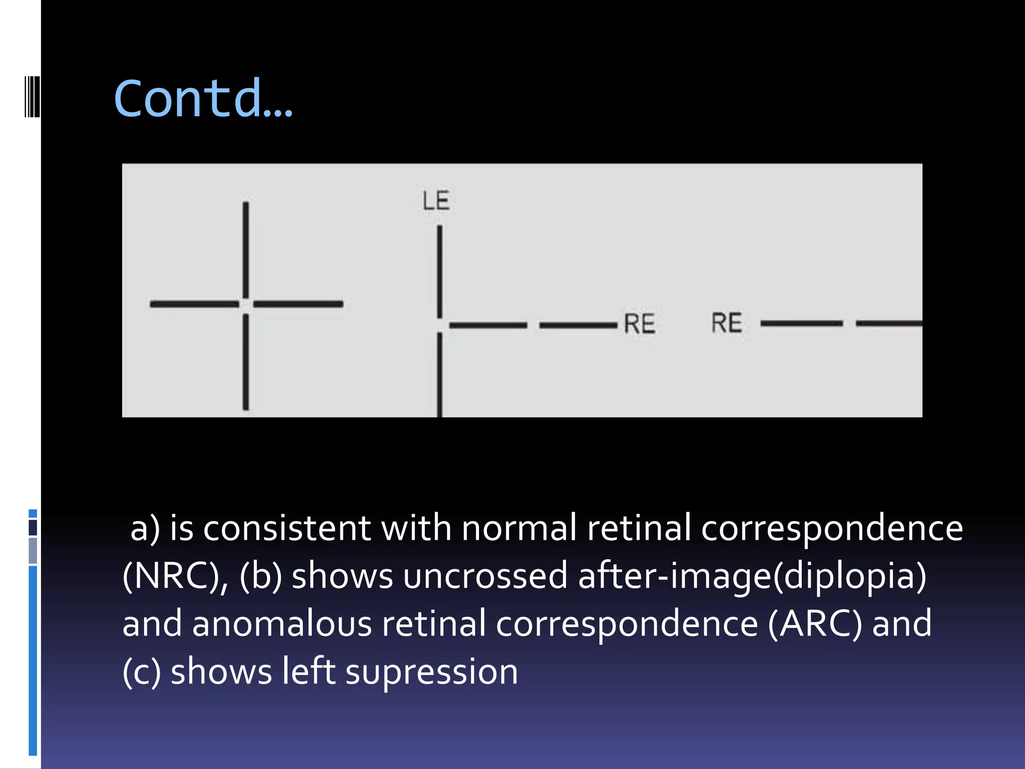 Contd…
a) is consistent with normal retinal correspondence
(NRC), (b) shows uncrossed after-image(diplopia)
and anomalous retinal correspondence (ARC) and
(c) shows left supression
 