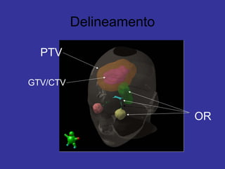 Delineamento
PTV
GTV/CTV
OR
 