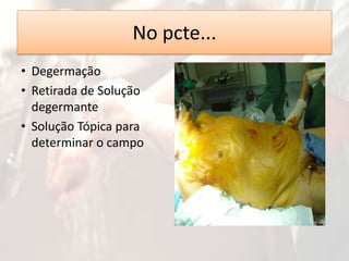 No pcte...
• Degermação
• Retirada de Solução
degermante
• Solução Tópica para
determinar o campo

 