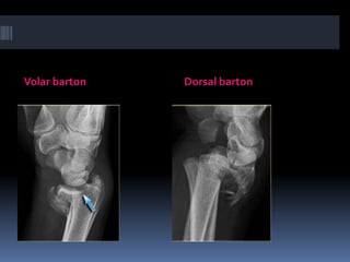 Assessent and radiology of distal end radius fracture | PPTX