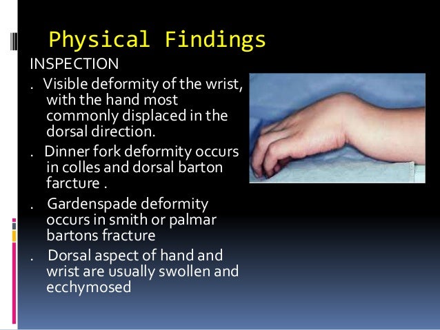 Assessent And Radiology Of Distal End Radius Fracture
