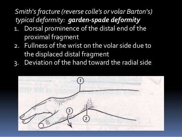 Assessent And Radiology Of Distal End Radius Fracture