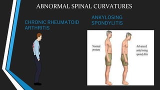 ABNORMAL SPINAL CURVATURES
CHRONIC RHEUMATOID
ARTHRITIS
ANKYLOSING
SPONDYLITIS
 