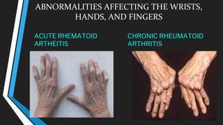 ABNORMALITIES AFFECTING THE WRISTS,
HANDS, AND FINGERS
ACUTE RHEMATOID
ARTHEITIS
CHRONIC RHEUMATOID
ARTHRITIS
 