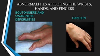 ABNORMALITIES AFFECTING THE WRISTS,
HANDS, AND FINGERS
BOUTONNIERE AND
SWAN-NECK
DEFORMITIES
GANLION
 