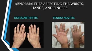 ABNORMALITIES AFFECTING THE WRISTS,
HANDS, AND FINGERS
OSTEOARTHRITIS TENOSYNOVITIS
 