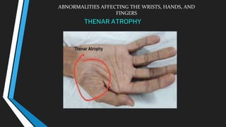 ABNORMALITIES AFFECTING THE WRISTS, HANDS, AND
FINGERS
THENAR ATROPHY
 